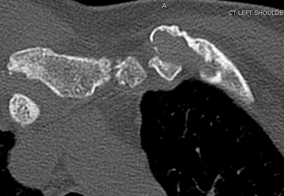 SCJ CT Anterior Dislocation